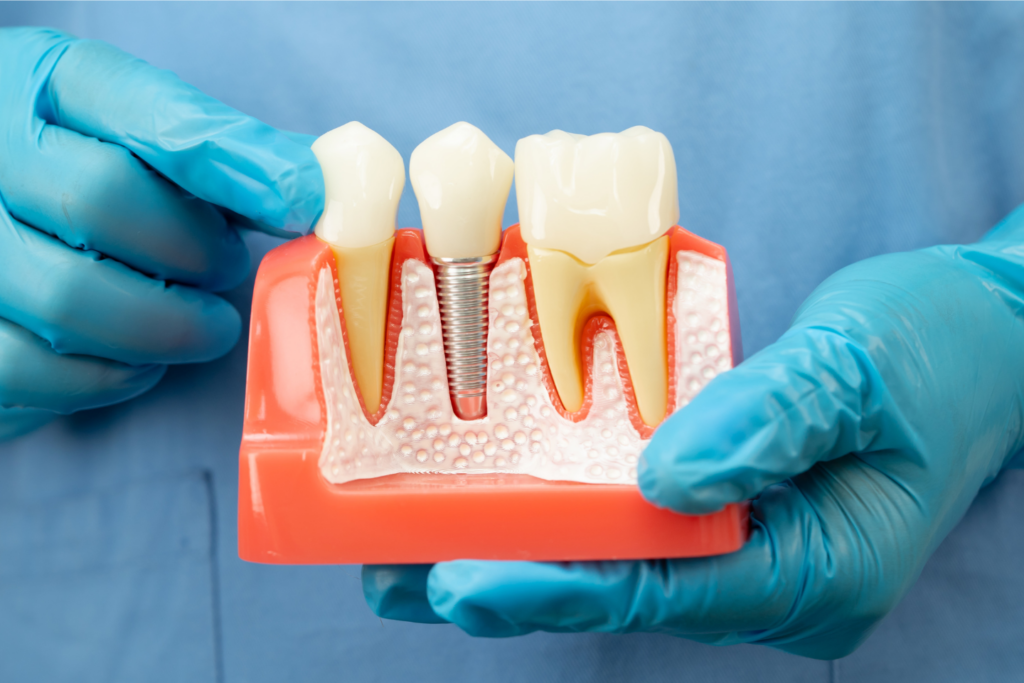 How Long Do Dental Implants Last? | Dentist in New Milton