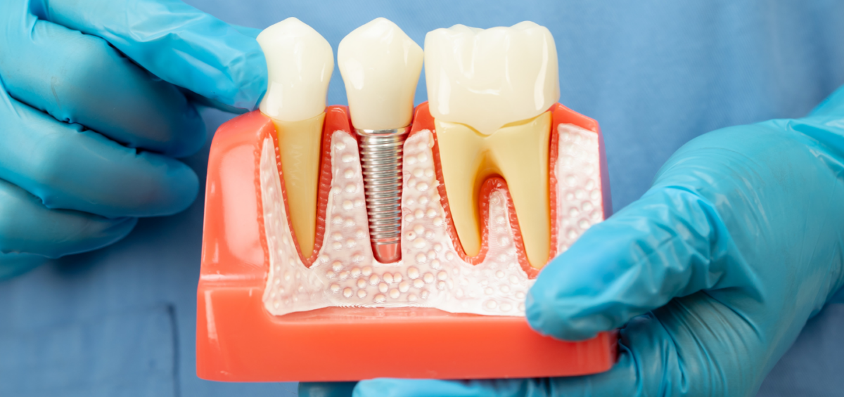 How Long Do Dental Implants Last? | Dentist in New Milton