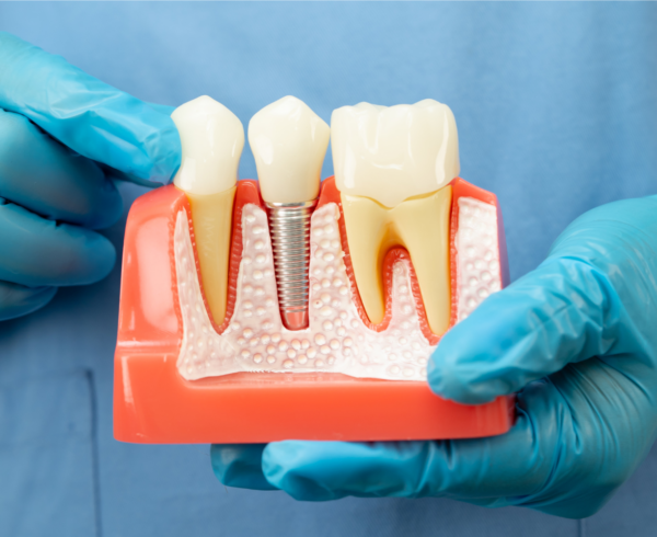 How Long Do Dental Implants Last? | Dentist in New Milton