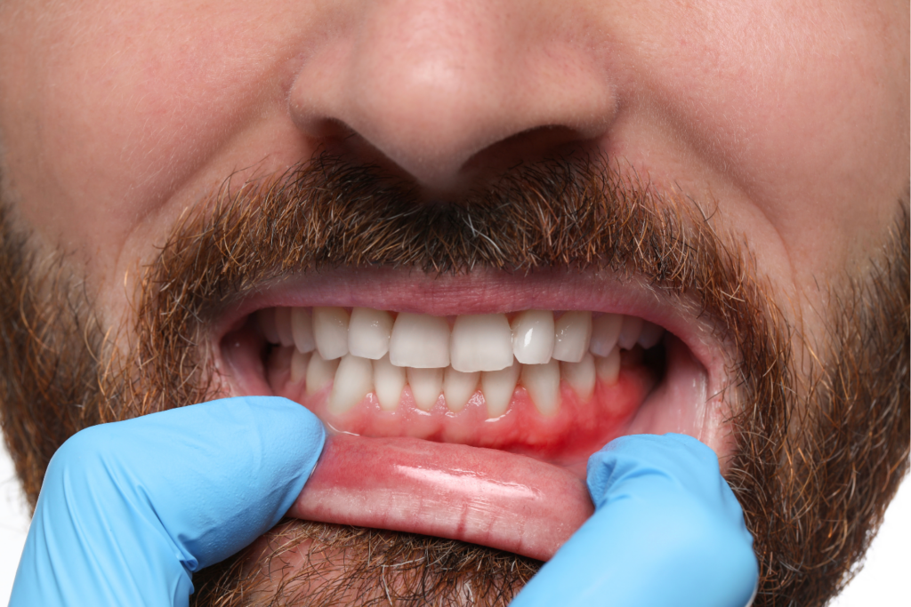 Can Gum Disease Be Reversed? Signs & Treatment