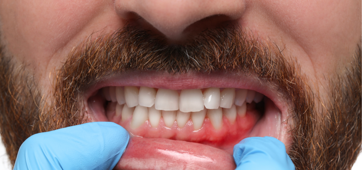 Can Gum Disease Be Reversed? Signs & Treatment