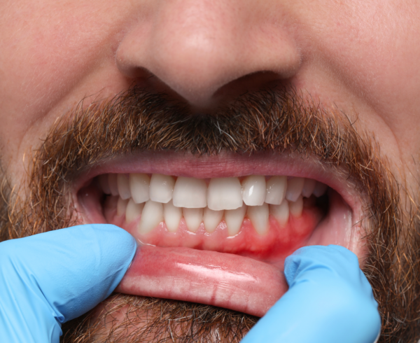 Can Gum Disease Be Reversed? Signs & Treatment