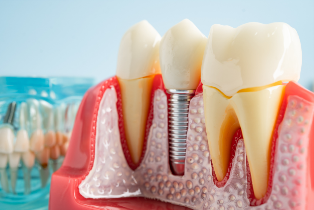 Dental Implants vs Dentures: Which Is Better?