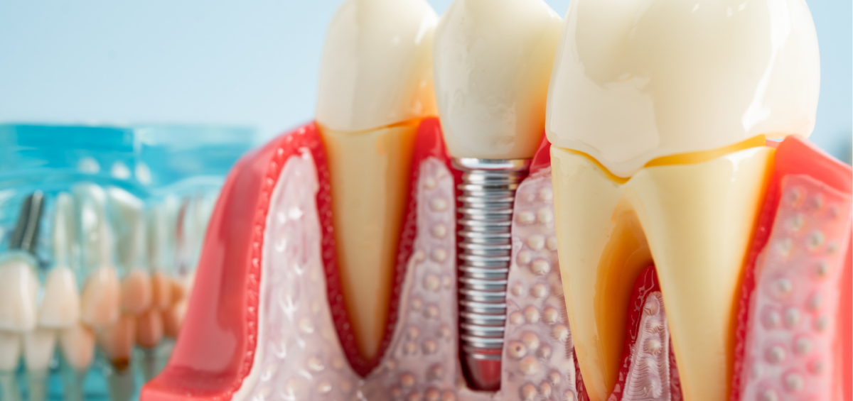 Dental Implants vs Dentures: Which Is Better?