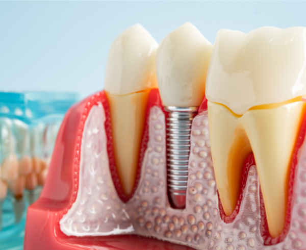 Dental Implants vs Dentures: Which Is Better?