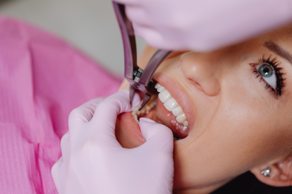 Wisdom Teeth Removal: 5 Signs You Need a Dentist