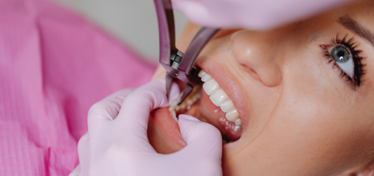 Wisdom Teeth Removal: 5 Signs You Need a Dentist