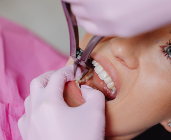 Wisdom Teeth Removal: 5 Signs You Need a Dentist
