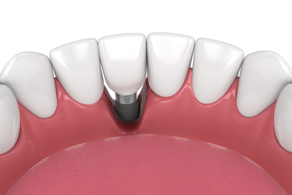 Is Bone Grafting Always Needed for Dental Implants?