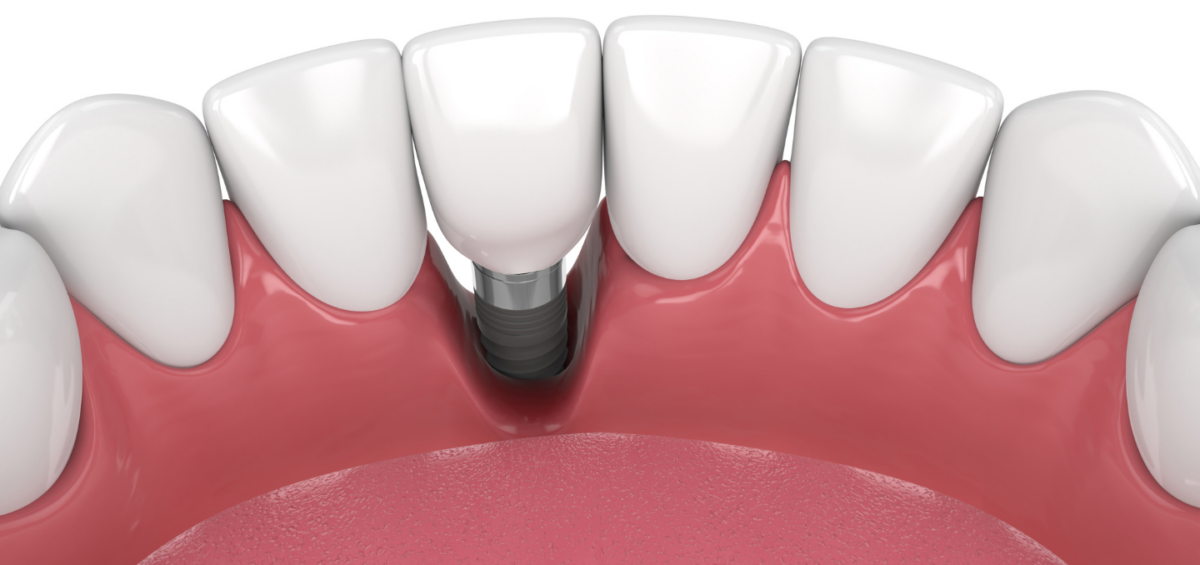 Is Bone Grafting Always Needed for Dental Implants?