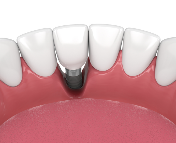 Is Bone Grafting Always Needed for Dental Implants?