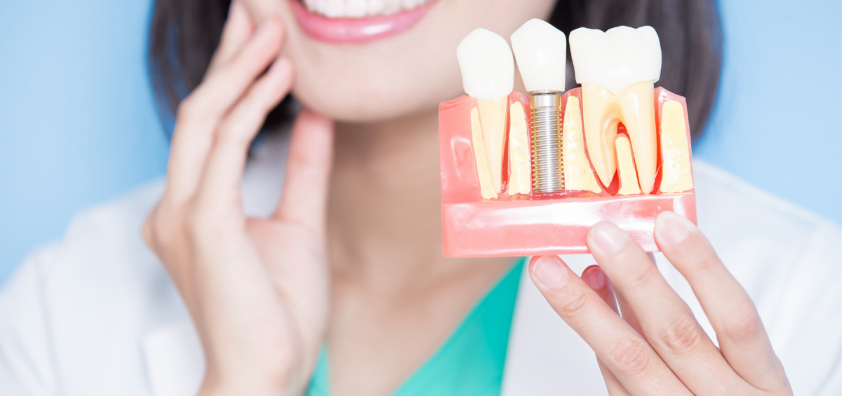 Do Dental Implants Look and Feel Like Natural Teeth?