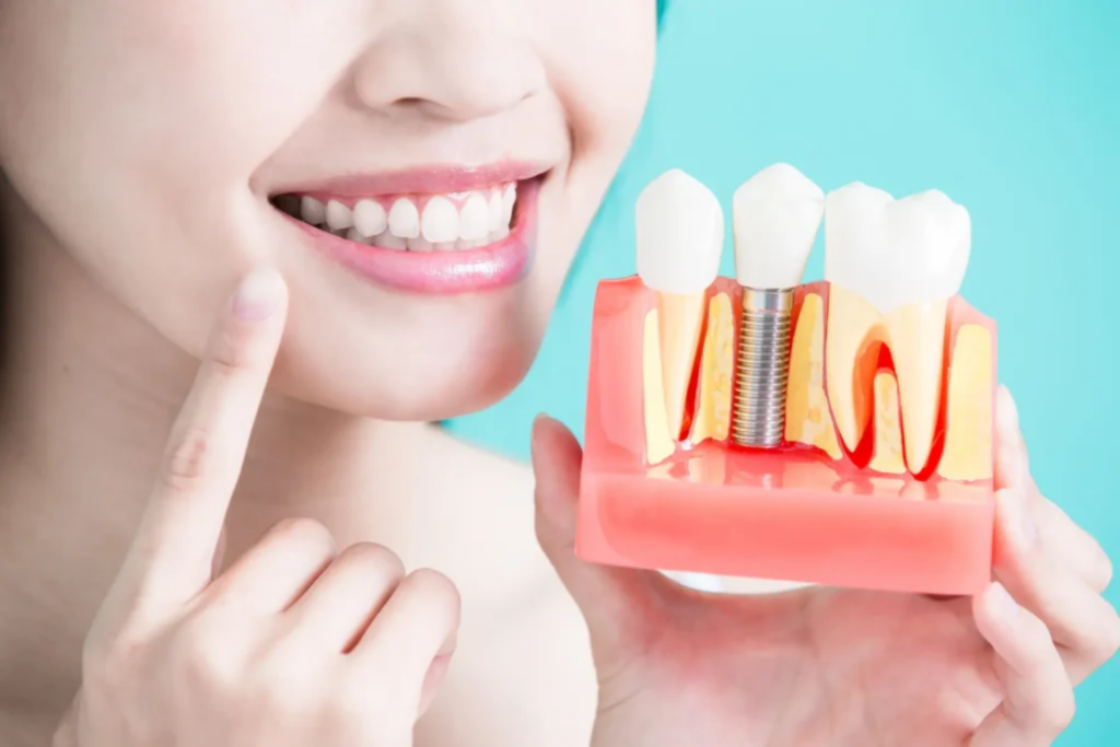 How Long Does the Dental Implant Process Take?