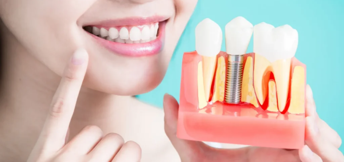 How Long Does the Dental Implant Process Take?