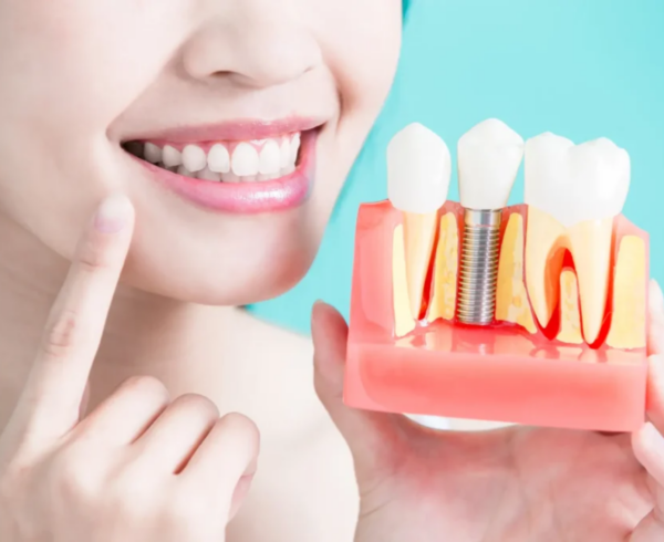 How Long Does the Dental Implant Process Take?